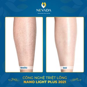 công nghệ triệt lông Nano Light Plus