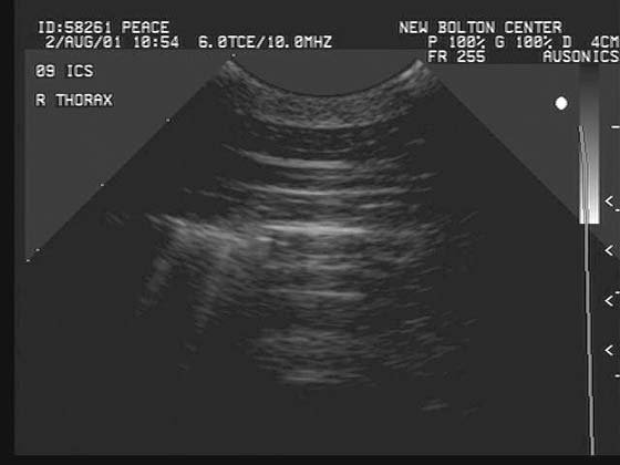 Sonographic appearance of pneumothorax