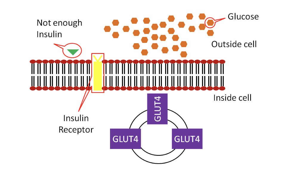 Schematic showing that in type 1 diabetes, the pancreas does not make enough insulin, so glucose transporters (GLUT-4) do not open on the cell membrane, and glucose is stuck outside the cell. 