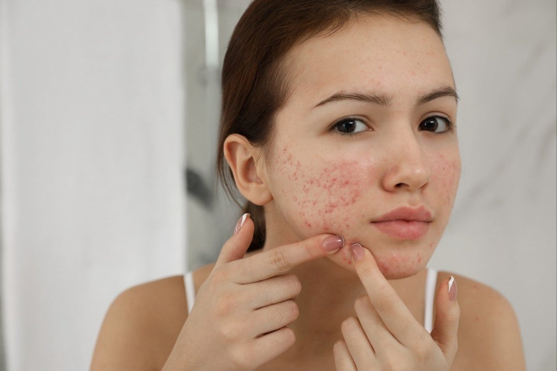 Giải mã 14 hiểu lầm về mụn