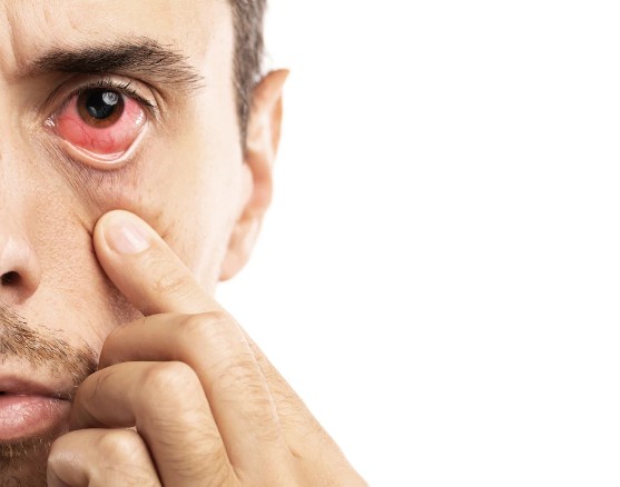 Swollen Eyes And Eyelids: Why And How To Treat Them