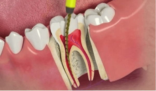 عصب کشی از راه حل های درمانی برای دندانی است که ریشه به شدت آسیب دیده است.
