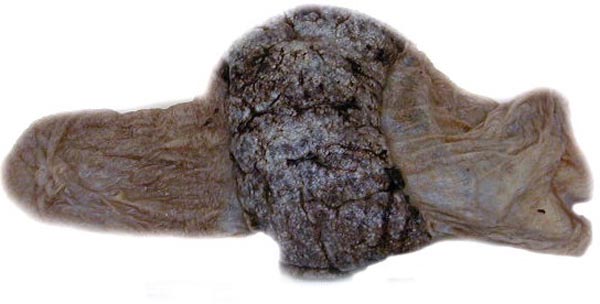 External appearance of tiger placenta, one of triplets