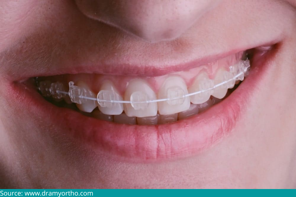 D:\Digicore\UNOSEARCH\Dr. Suhrab Singh - Neodental\Adult Aligners For A Smile Makeover\Source ceramic.jpg