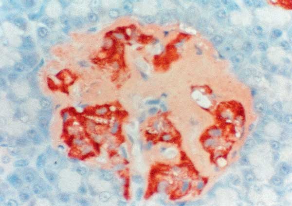 Pancreatic islet of a cat with massive deposition of islet amyloid which consists mainly of precipitates of the beta-cell hormone amylin