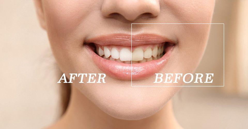 affordable teeth whitening in Toronto