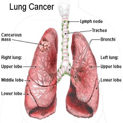 http://cancer-treatment-madurai.com/types-of-cancer-lung-cancer.php