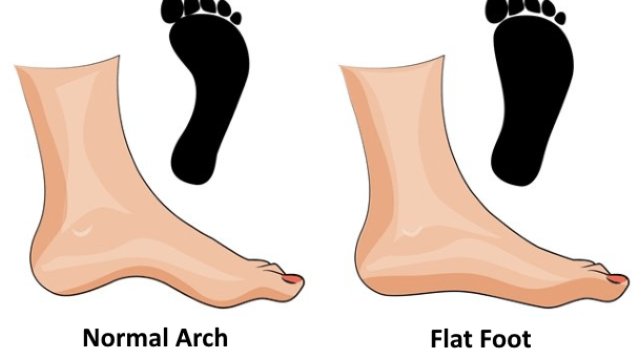 A chart Normal Arch foot and Flat Foot