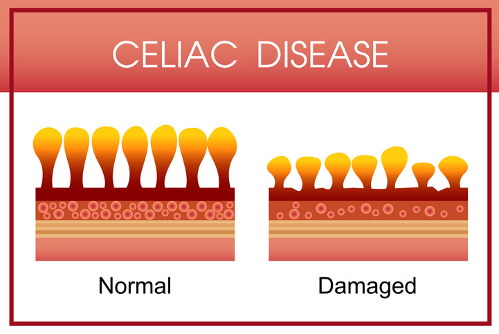 Damaged Intestines Due to Celiac Disease