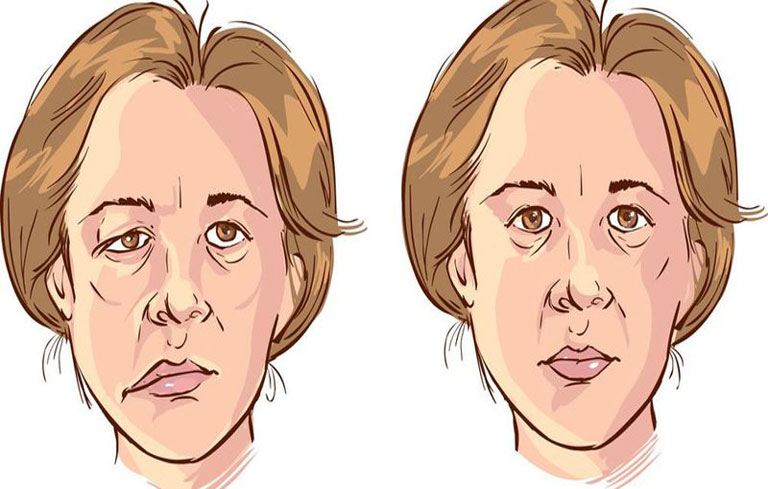dấu hiệu tai biến mạch máu não