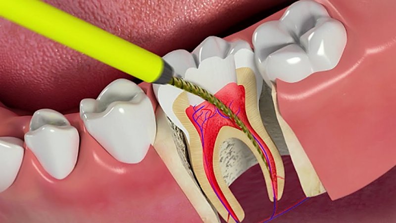 Vi khuẩn tấn công tủy răng khiến tủy bị tổn thương