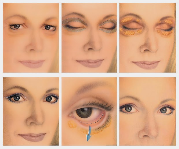 http://cosmetic-surgeon-online.com/treatments-blepharoplasty.html