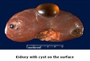 kidney cancer