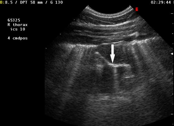 Sonogram of an air bronchogram in the right lung obtained from the 10th intercostal space at a level 4 cm dorsal to a line parallel with the point of the shoulder in a horse with severe pneumonia.