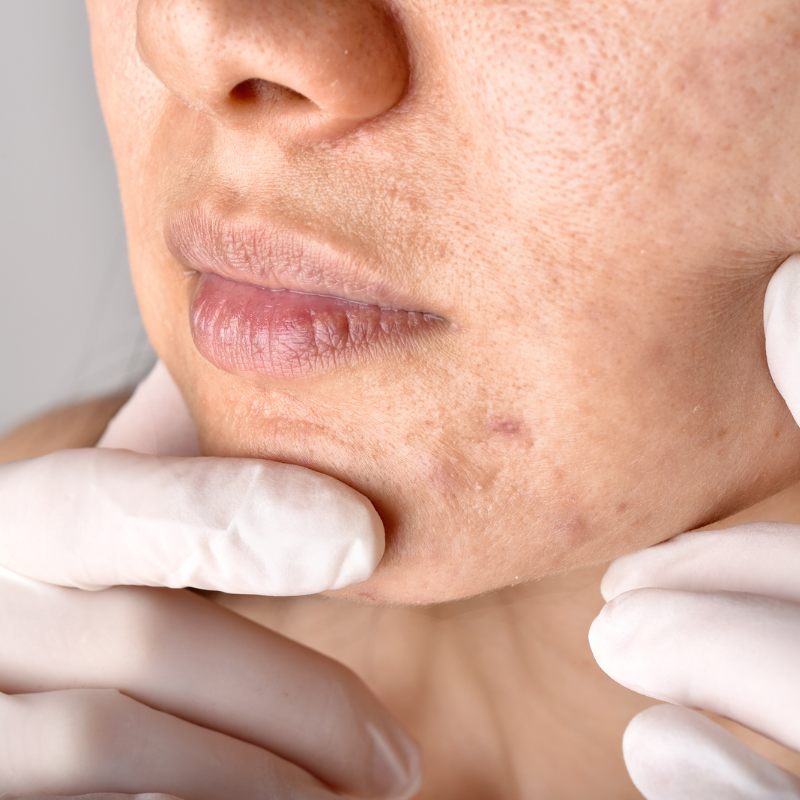A dermatologist can perform a thorough examination, identify any underlying allergies, and suggest specific treatments.
