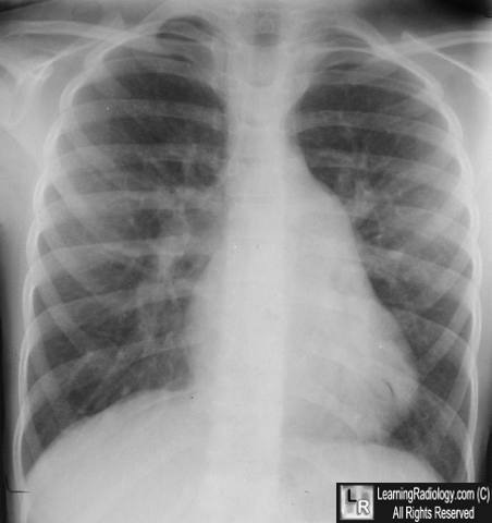  Aumento do tronco da artéria pulmonar e dos vasos pulmonares (comunicação interatrial)