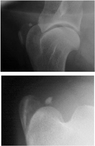 Lateral and craniproximal – craniodistal or "skyline" radiographic views showing two calcific deposits in the supraspinatus tendon