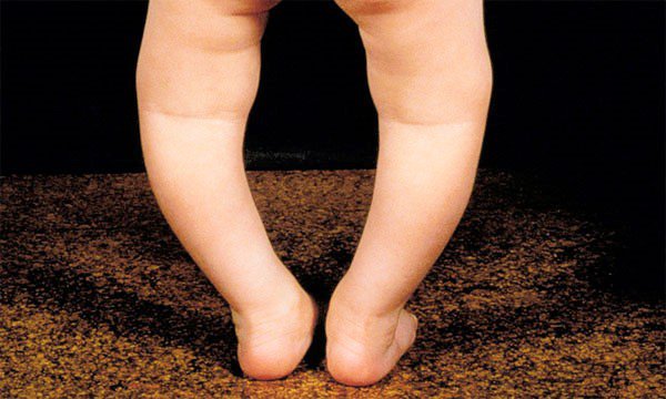 Dấu hiệu chân vòng kiềng của trẻ thiếu Vitamin D