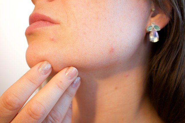 Identifying the type of acne you’re suffering from is the first step. 