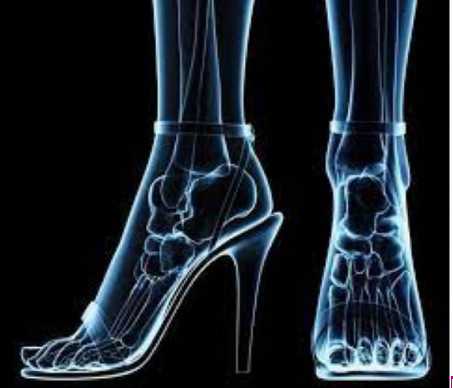 Common Foot Problems Caused by High Heel Shoes