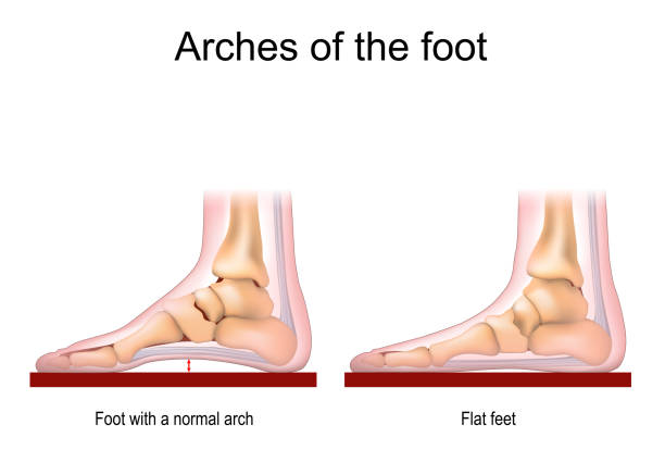 flat feet