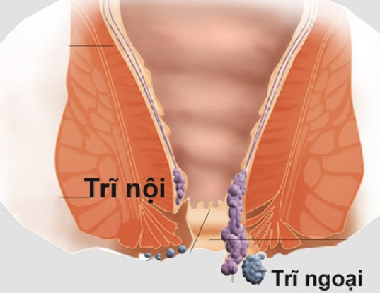 biểu hiện của bệnh trĩ