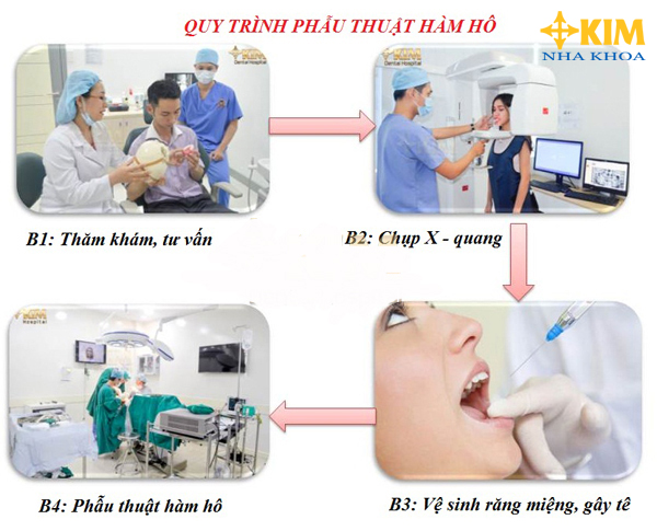 Cách phẫu thuật mới mới,chữa hàm hô không gây biến chứng