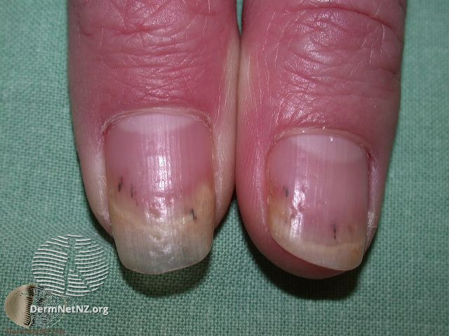 Psoriatic Arthritis and Nails: Symptoms and Treatment | MyPsoriasisTeam