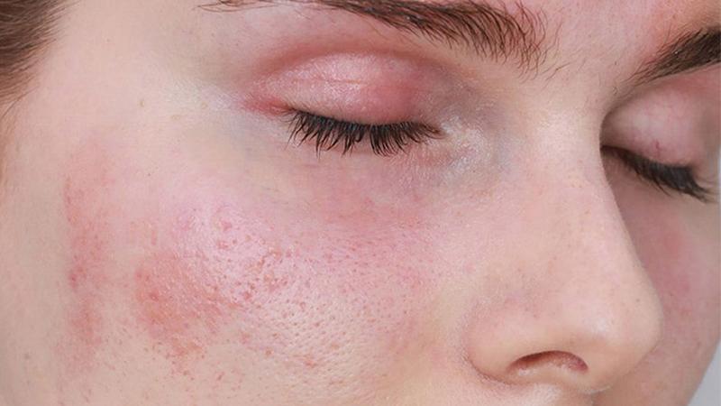 Da nhạy cảm là da bị sưng, đỏ, căng khi tiếp xúc với các sản phẩm chăm sóc da