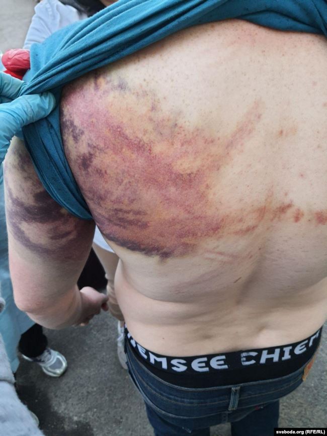 Следы избиений на спине одного из задержанных после президентских выборов в Минске