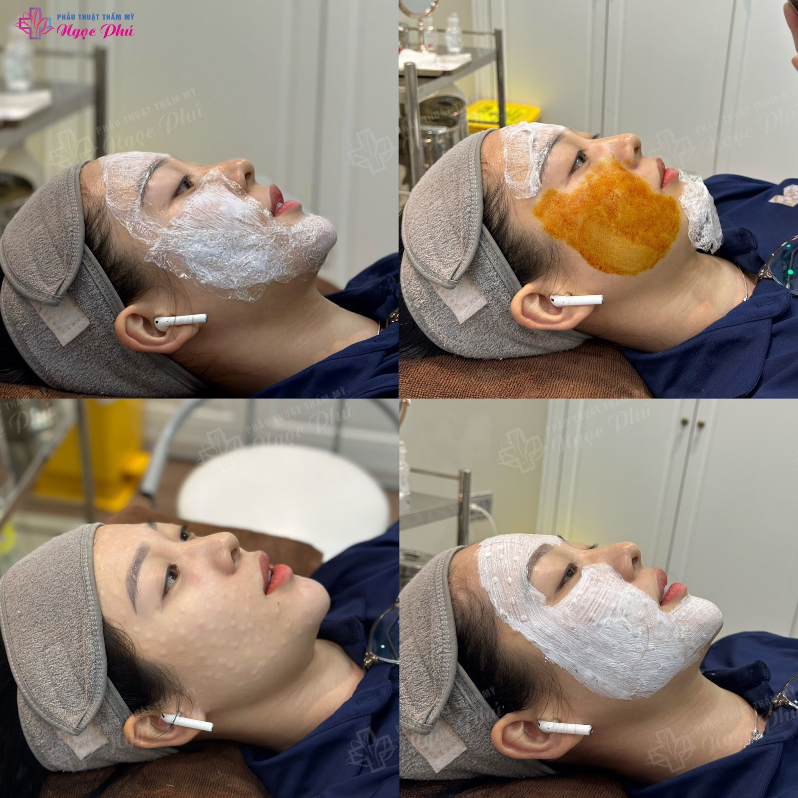 Cách da mặt đẹp bằng kỹ thuật tiêm meso hay còn gọi là tiêm mesotherapy là một trong những phương pháp làm đẹp da mặt hiện đại
