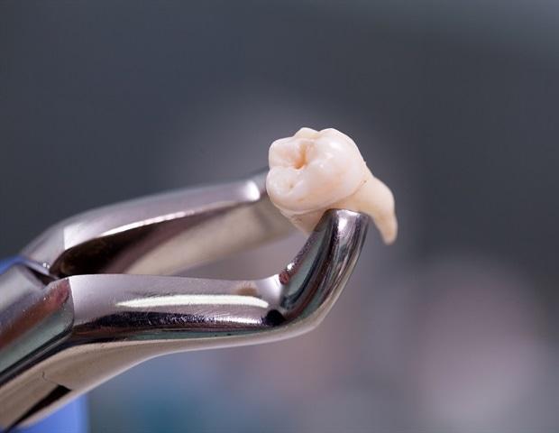 tooth extraction in Newmarket 