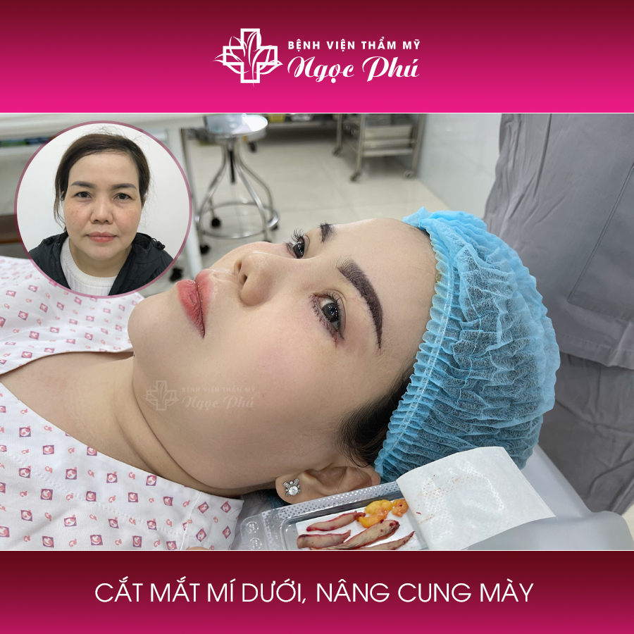 Hình ảnh khách hàng thực tế nâng cung mày tại bệnh viện Thẩm mỹ Ngọc Phú