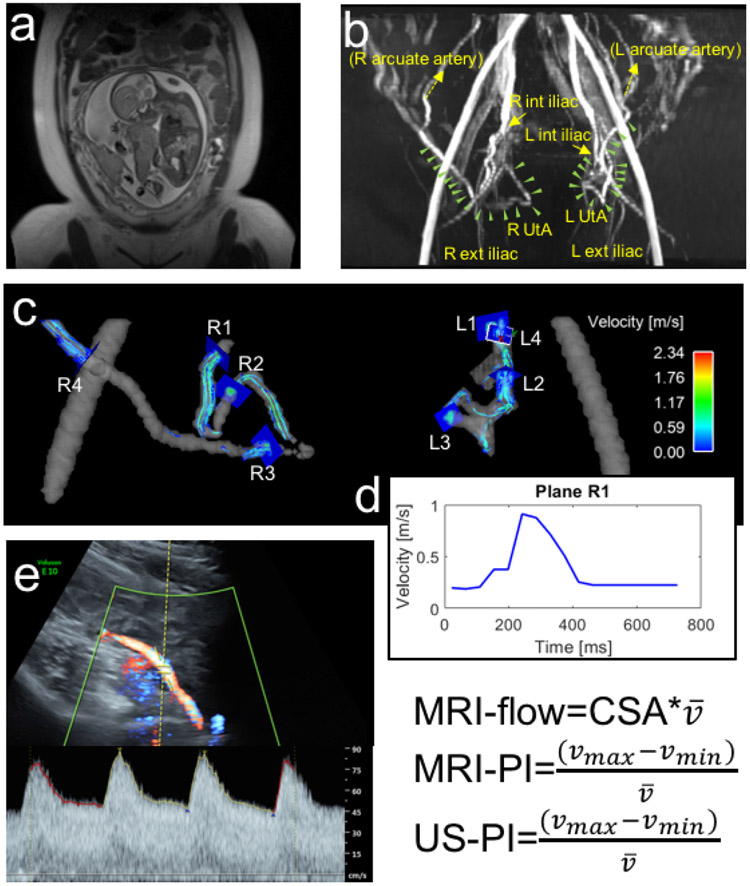 Diagram outlining methodological workflow for 4D flow MRI and ultrasound hemodynamic parameter extraction. Hwuang et al., Ultrasound Obstet Gynecol, 2021.