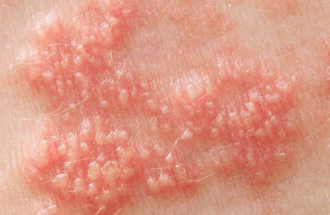 Các mụn rộp sinh dục