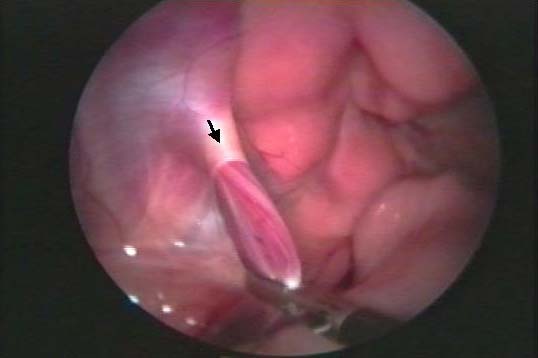 Traction being applied to the testicular vessels to pull the testis into the abdomen. Arrow: vaginal ring.