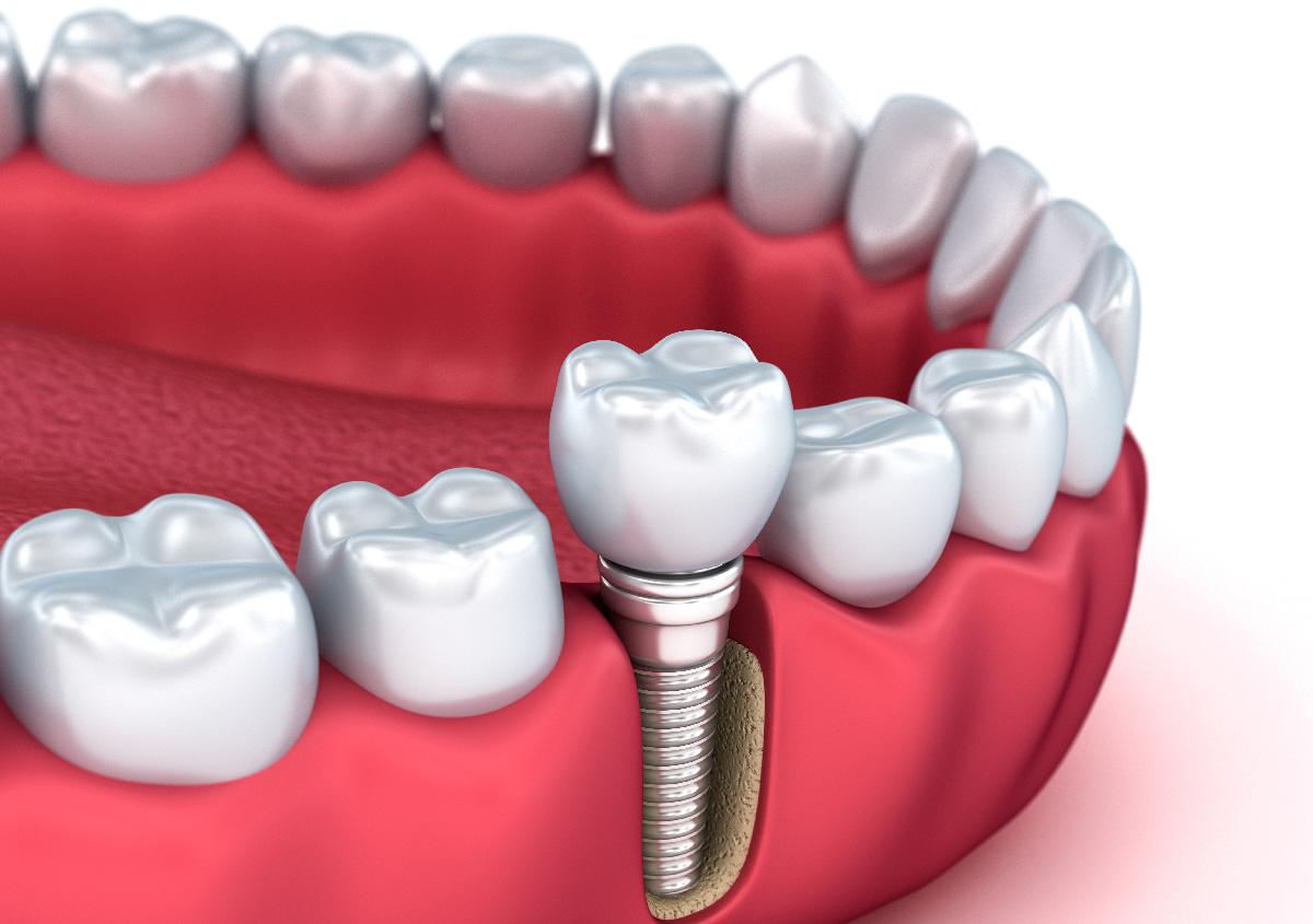 dental implants in North York