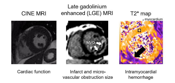 Cardiac magnetic resonance imaging techniques. MRI provides the ability to collect CINE, LGE, and relaxation (T2*) maps from the heart. Each image is a short axis view of the heart. Moon, Brianna F., "Iron Imaging In Myocardial Infarction Reperfusion Injury" (2020). Publicly Accessible Penn Dissertations. 3804.