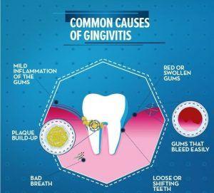 What is gingivitis causes? How to treat gum disease? | Preferred Dental