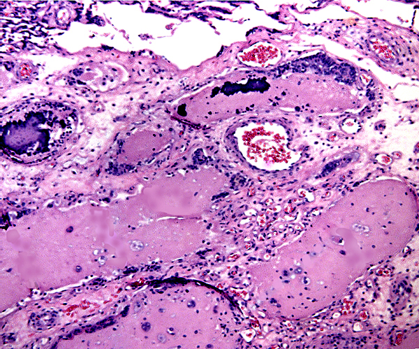 Giant cells in subplacenta with hyaline debris and focal calcification.