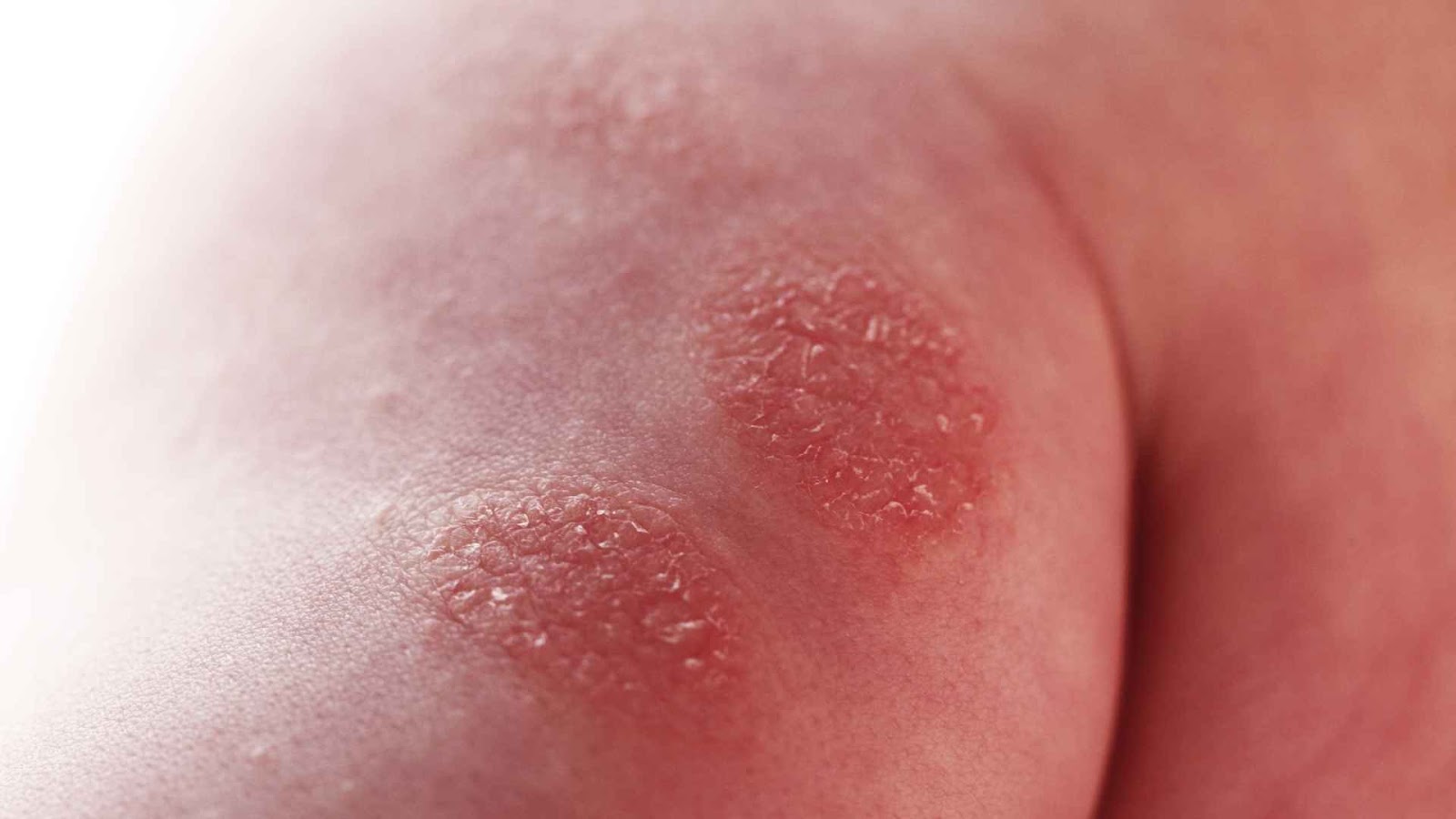An eczema flare up