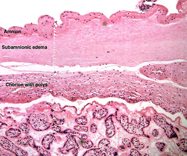 Fetal surface with mild inflammatory infiltration of the chorion