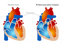 What is Pulmonary valve stenosis