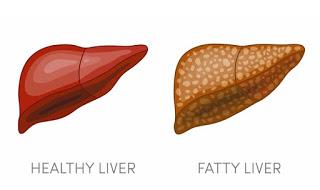Ayurvedic Treatment for Fatty liver
