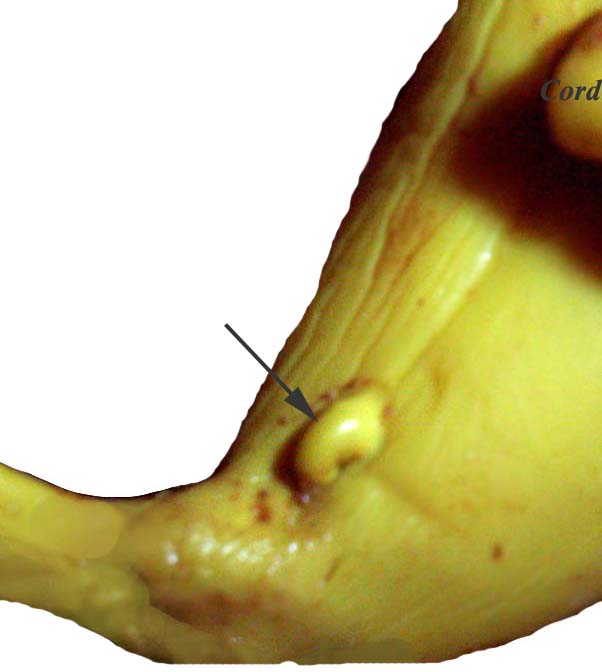 Tail portion of fetus with the remarkably prominent clitoris at arrow