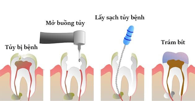 Kỹ thuật lấy tủy bị viêm nhiễm ở răng