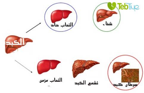 صورة توضيحية لمضاعفات الإصابة بالتهاب الكبد