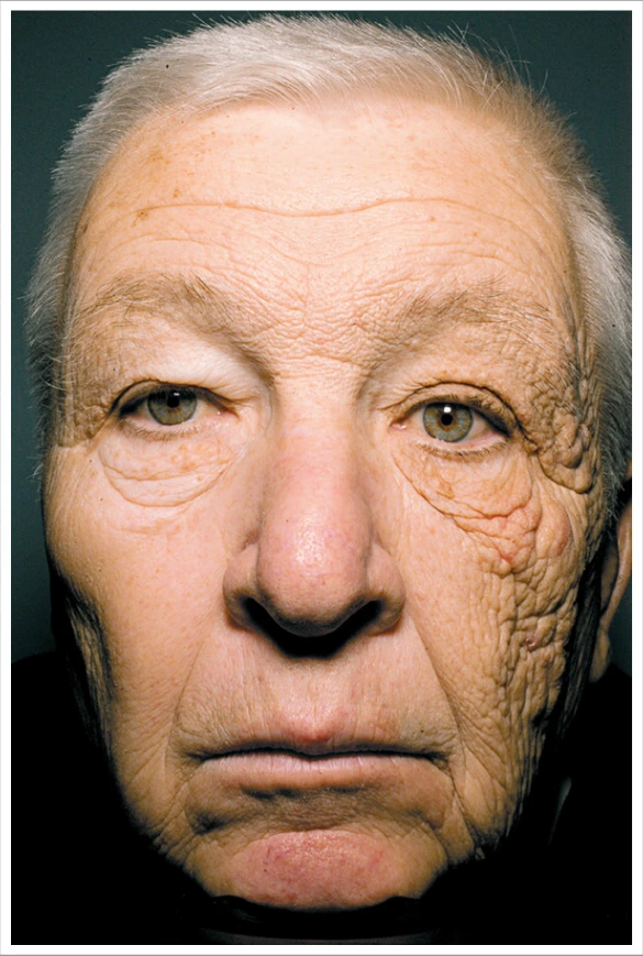 Benefits of Sunscreen - prevents photoaging