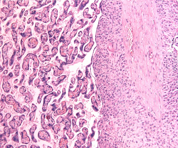 Low power view of term villi and large villus with cytotrophoblastic excess above. Higher magnification of terminal villi and cytotrophoblast column at left