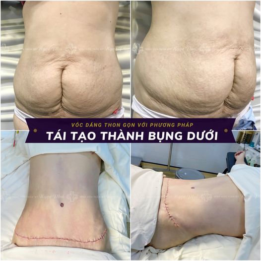Hình ảnh khách hàng trước và sau khi hút mỡ bụng tại Phẫu thuật Thẩm mỹ Thẩm Mỹ Việt Nam